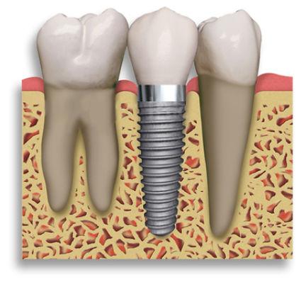 Salud bucal (Implantes)