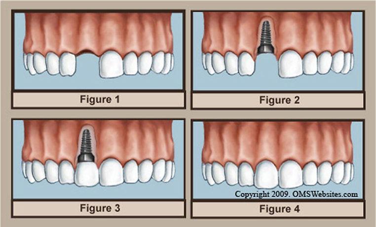 Salud bucal (Implantes)